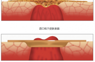造口护理：为什么要使用凸面底盘？